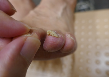 水虫 爪水虫 白癬 のせ皮ふ科 大阪府茨木市の皮膚科 美容皮膚科